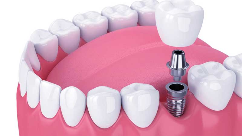 Exploring the Cost of Dental Implant