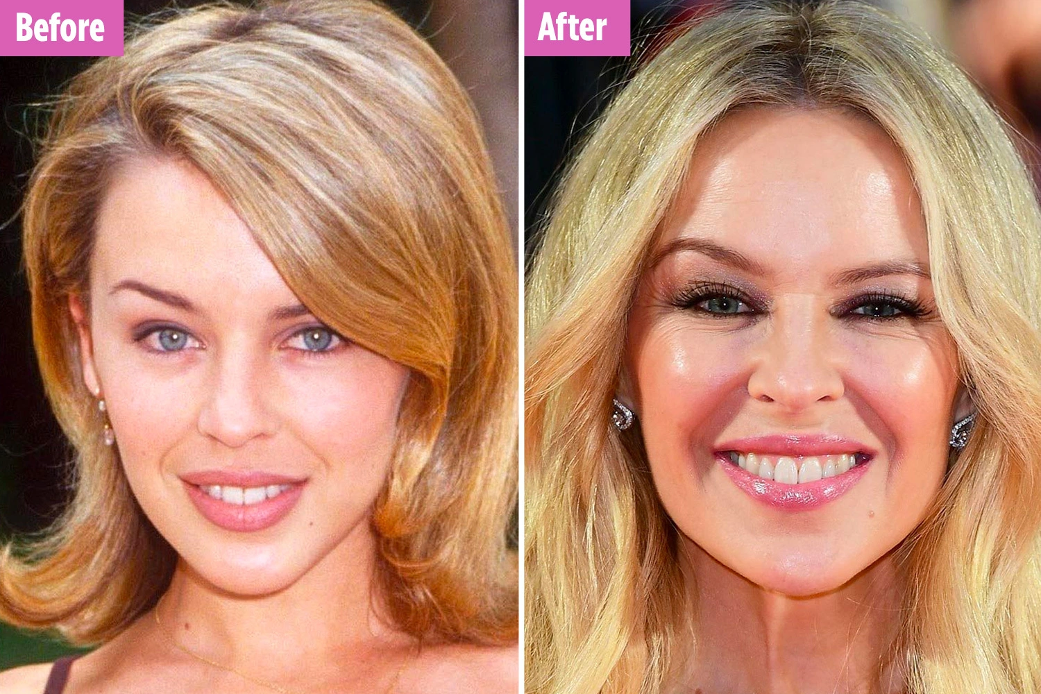 The Benefits of 1ml Cheek Filler Before and After